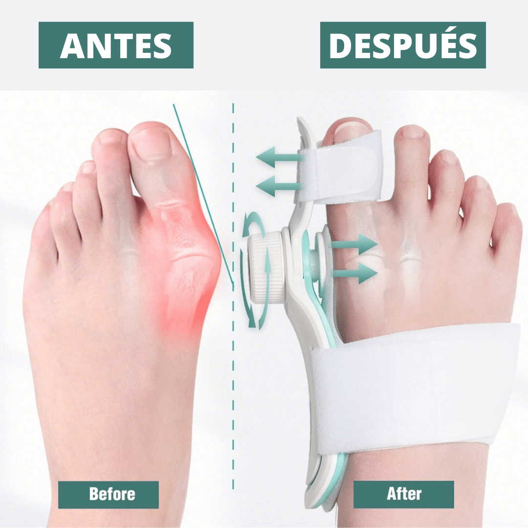 Corrector de Juanetes Graduable Con Perilla y Gel Fresco (1 Unidad) - Muy Moderna Uruguay