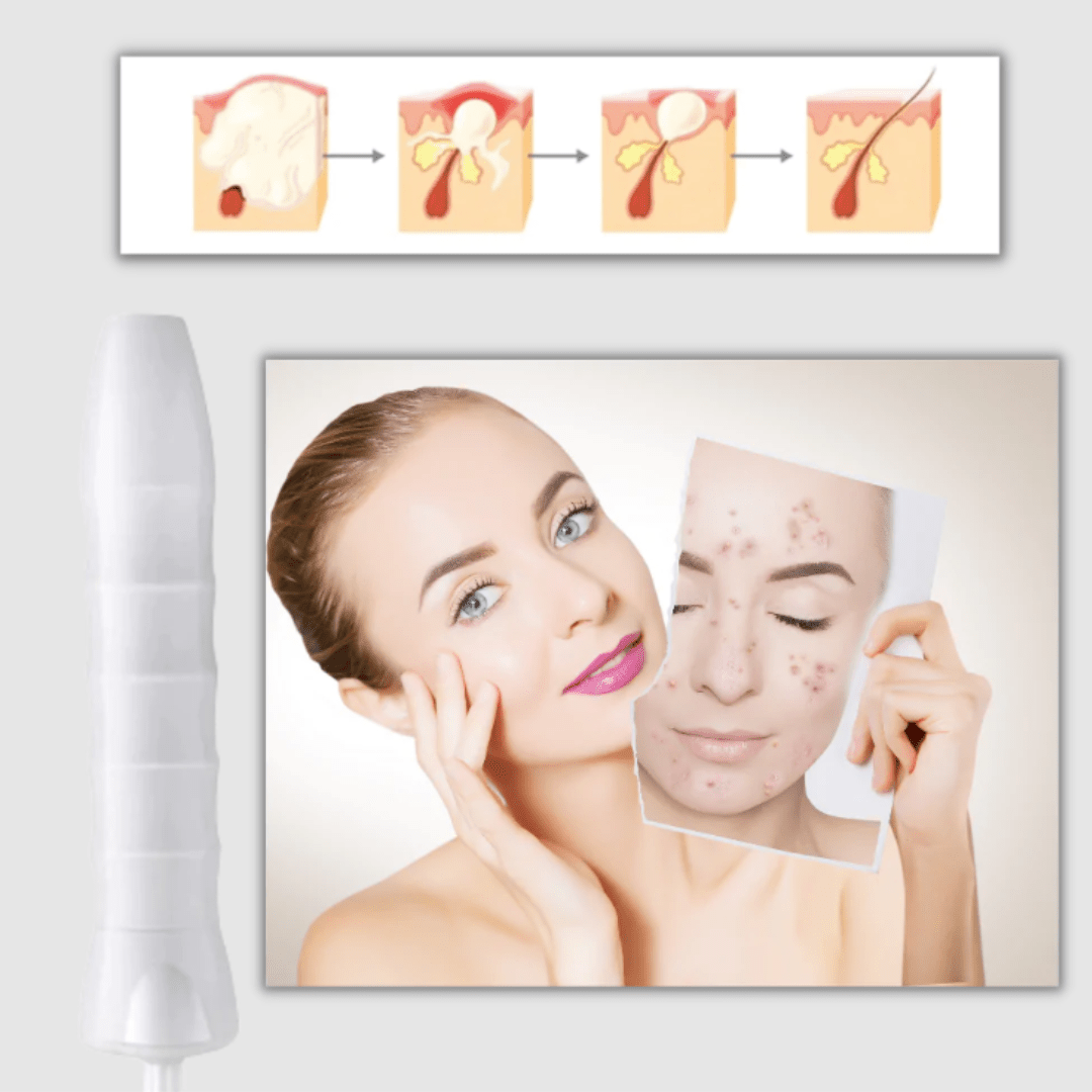 FaceTone Dispositivo de Alta Frecuencia Facial - Muy Moderna Uruguay
