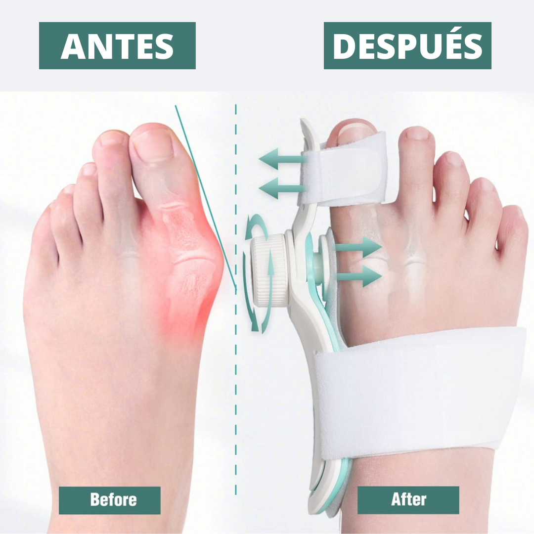 Corrector de Juanetes Graduable Con Perilla y Gel Fresco (1 Unidad)